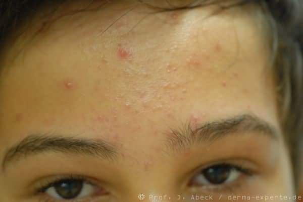 Acne papulopustulosa. Im Stirnbereich entzündliche Knoten und Pusteln neben überwiegend geschlossenen (weißen) Komedonen